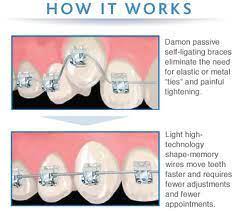 Maybe you would like to learn more about one of these? 9 Damon Braces Ideas Damon Braces Braces Damon