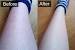 Infected Ingrown Hair On Leg