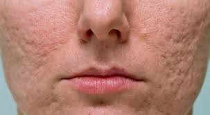 Image result for acne face
