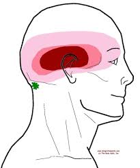 Understanding Trigger Points Headache All Over Or In A Band Around The Head Trigger Points Headache Trigger Point Therapy
