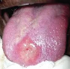 Lupus vulgaris lupus vulgaris (tuberculosis cutis luposa, icd10: Cutaneous Tuberculosis Microbiology Spectrum
