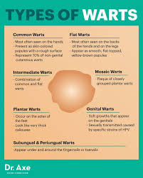 How To Get Rid Of Warts Naturally Without Surgery Types Of Warts Warts Get Rid Of Warts
