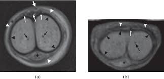 Buck's fascia over the corpora spongiosum which is deficient ventrally in hypospadias is not conclusion: Figure 2 From Mri Of The Penis Semantic Scholar