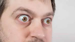 Image result for Proptosis