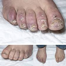 Image result for Beau lines feet