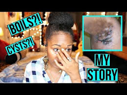 Boils Under My Armpits Amp Inner Thighs My Hidradenitis Suppurativa Horror Story Youtube Whiten Underarms Fast Dark Underarms How To Whiten Underarms