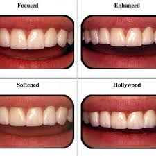 How are snap on veneers different to traditional dental veneers? How To Choose The Best Veneers For Your Face Shape Dr Raanan