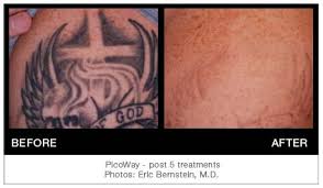 Call now for free consultation: Picoway Advanced Laser Tattoo Removal Lakes Dermatology