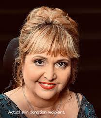 Skin donation information