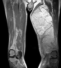 Image result for Liposarcoma