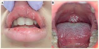 Image result for Hand foot and mouth disease HFMD roof of mouth