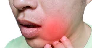 أسباب انتفاخ الوجه المفاجئ ويب طب