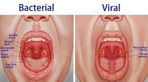 Life We Live 4 Cure Sickness Naturally Chronic Sore Throat Swollen Tonsils Pharyngitis