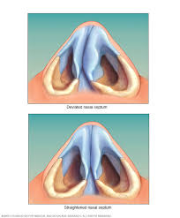 Suggest treatment for nasal vestibulitis. What Is A Deviated Nasal Septum Health Life Media