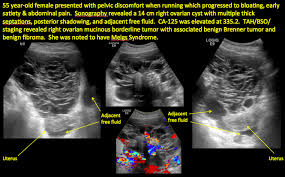 A harmless ovarian cyst can show up on an ultrasound and masquerade as cancer. Imaging The Suspected Ovarian Malignancy 14 Cases Mdedge Obgyn