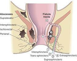 Diagnosis and treatment are discussed. Fistula In Ano Fch Clinic