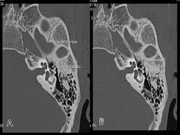 Image result for Ossicular Chain Disruption