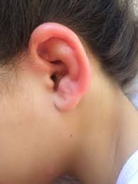 Image result for Relapsing Polychondritis