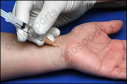 Carpal Tunnel Injections Orthosports Orthopaedic Surgeons