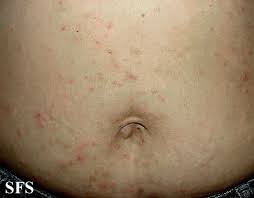 Sarna humana linear unit bebes tratamiento. Escabiose Ou Sarna Sociedade Brasileira De Dermatologia