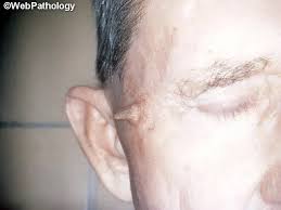 Image result for cornu cutaneum)