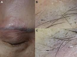 .on hair follicle turning black: The Dermoscopic Comma Zigzag And Bar Code Like Hairs Markers Of Fungal Infection Of The Hair Follicles Sciencedirect