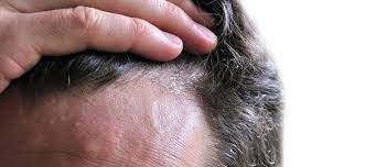 Seboreik Dermatit Nedir Cilt Beyazlatma Sac Hizli Sac Uzama