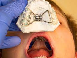 牙科保健】把握顎骨生長黃金時期上顎擴張器的作用| 親子王國
