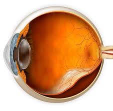 Image result for Retinal Detachment