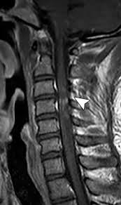Mariam stepanyan, art director 27th december 2019. Diagnostic Approach To Intrinsic Abnormality Of Spinal Cord Signal Intensity Radiographics