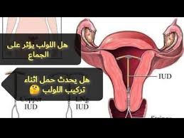 هل يحدث حمل أثناء تركيب اللولب هل يؤثر اللولب على الجماع اللولب الهرموني اللوب الفضى وسائل منع الحمل Youtube