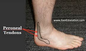 Lateral foot pain happens on the outer edges of your feet. Peroneal Tendonitis Footeducation