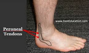 The knee consists of four bones that form three joints. Peroneal Tendonitis Footeducation