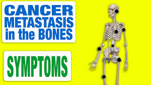 When cancer cells spread to the bones, the condition weakens the very frame on which the body rests. Cancer Metastasis In The Bones All Symptoms