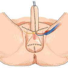 Jump to navigation jump to search. Phalloplasty In Iran Hamidreza Fathi M D Plastic Reconstructive Aesthetic Surgeon Irantreatments
