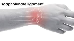 Image result for Scapholunate Dislocation