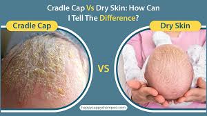 Image result for Dry Skin