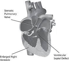 Pediatric tetralogy of fallot congenital heart defects detection using echocardiography. Tetralogy Of Fallot Chapter 64 Case Studies In Pediatric Anesthesia
