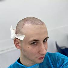 Man who was going bald spends £5k hair transplant