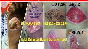 Terdapat empat asas terapi ulat ini, ia membersihkan luka, membasmi kuman, merangsang penyembuhan luka, merosak dan menghalang pembuatan biofilem. Wa 62 812 4229 2194 Jual Firmax3 Untuk Luka Kencing Manis Youtube