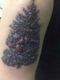 People with dark or black skin sometimes worry whether laser tattoo removal would be safe and however, research indicates that laser tattoo removal on darker skin is effective for most individuals. Tattoo Removal On Dark Tattoo Done Within The Last Year Photos