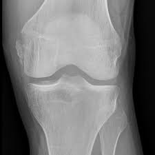 Pellegrini stieda syndrome is a medical problem which is characterized by pain, swelling and inflammation in the knee. Stieda Fracture Eurorad
