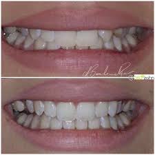 Neues Lachen Dank Veneers Vorher Nachher Foto Von Unserer Lieben Patientin Smilemakeover Veneers Schonezahne Vorhernachher Schone Zahne Zahne Neue Zahne