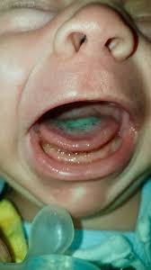 Image result for black hairy tongue symptoms