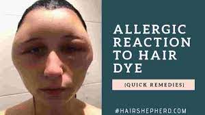 The best treatment for hair dye allergy is prevention. How Long Does An Allergic Reaction To Hair Dye Last