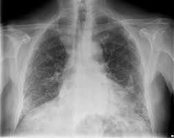 asbestosis adalah fibrosis intertestial kronis yang menyebar pada parenkim paru akibat menghirup serat asbes. Asbestosis Penyebab Gejala Dan Pengobatan Idn Medis