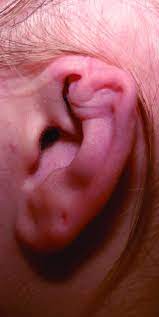 Profile View Of Deformed Ear One Year Post Infection Download Scientific Diagram