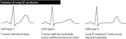 Image result for QT Interval