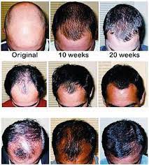 Bimatoprost's ability to increase hair and lash growth was found as a fortuitous accident. Pharmacological Treatment Of Alopecia Intechopen
