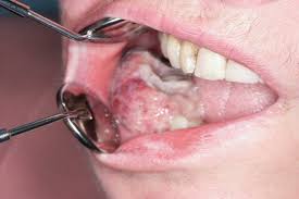 Image result for spinocellular carcinoma of the oral cavity